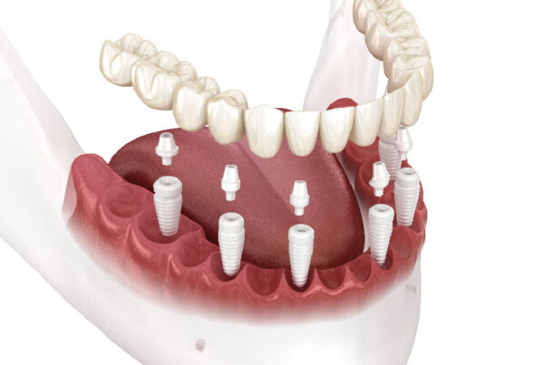 implant all on 4 all on 6 - 3d dental